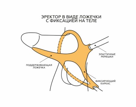 Эректор с фиксацией 